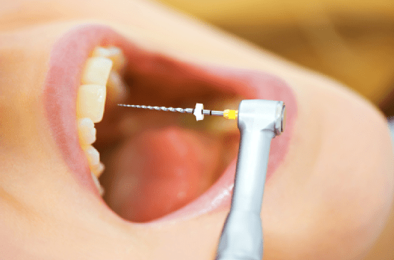 endodoncia