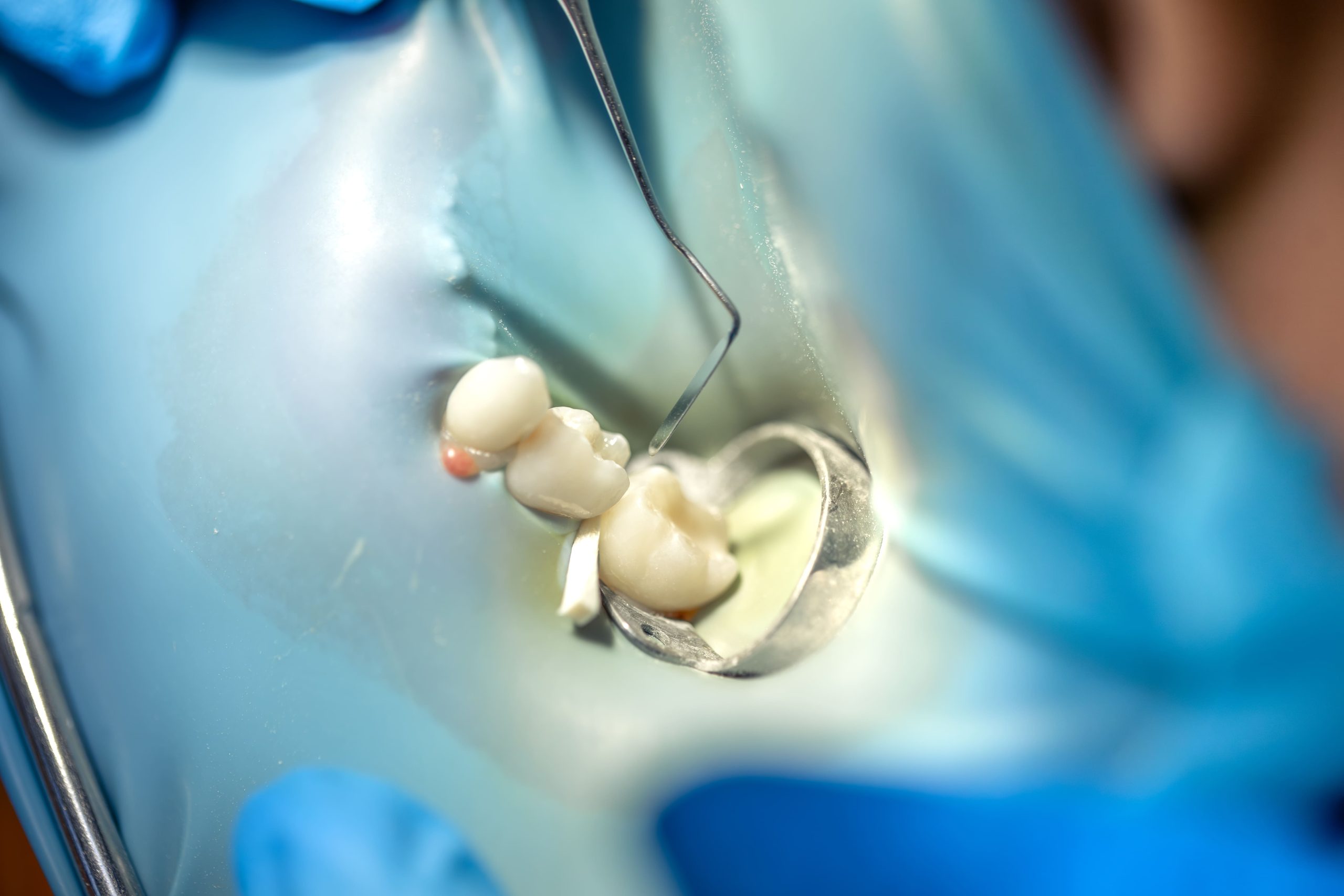 el-dentista-trata-el-diente-del-nino-usando-una-presa-de-goma-instalando-un-relleno-en-un-diente
